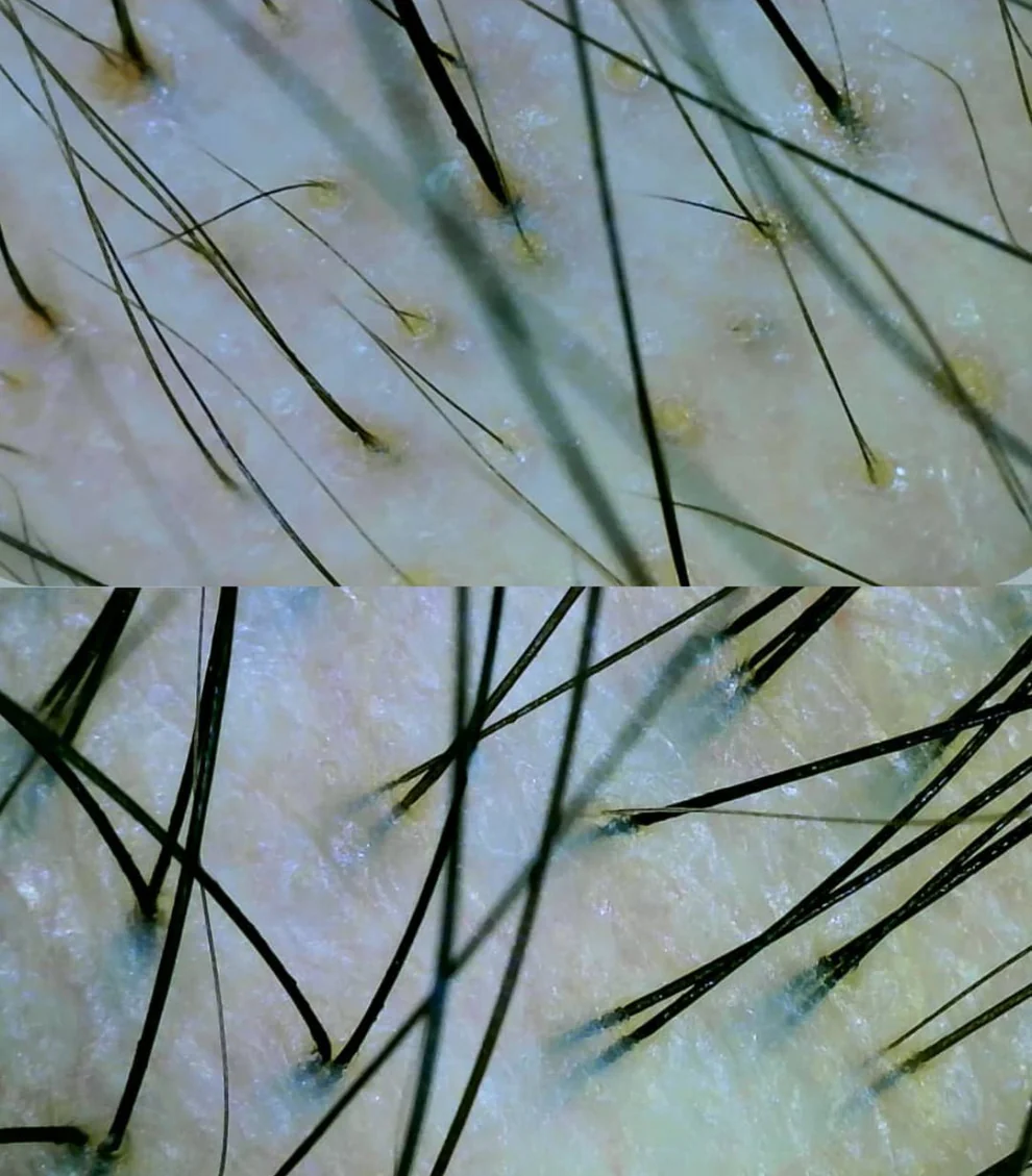 Tricoscopia digital
